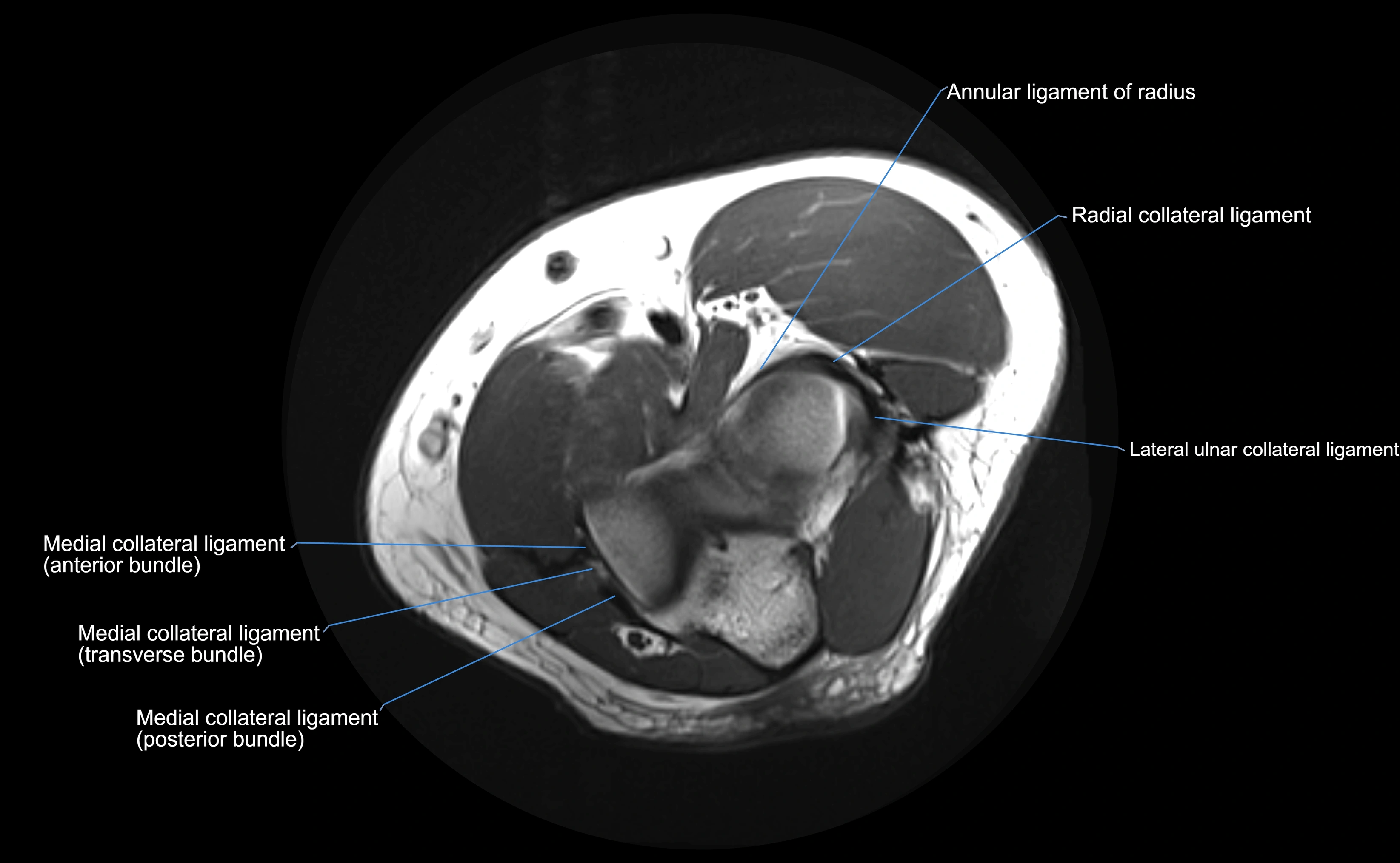 MRI elbow ligaments axial cross sectional anatomy 3T  radiology  image-img-00001-00016.webp